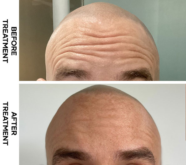 Before and after forehead Botox treatment at Cocoon Medical Spa Bali