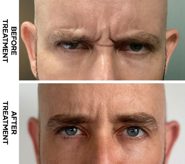 Frownline Botox results in Bali