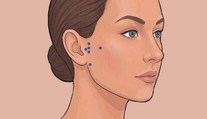 Injections points for TMJ Disorders