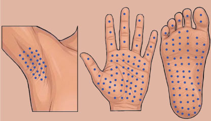 Injections points for Hyperhidrosis - Underarms, Palms, Soles.