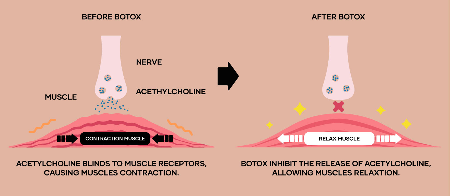 Illustration of a muscle before and after botox 